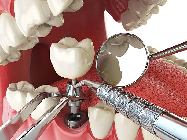 Best Emergency Tooth Extraction in Whispering Pines, NC